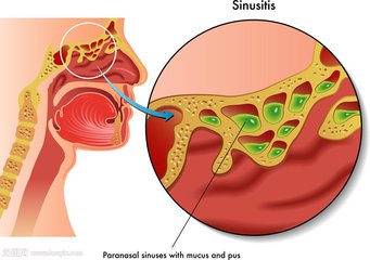 西安鼻窦炎哪家好,西安中大耳鼻喉医院